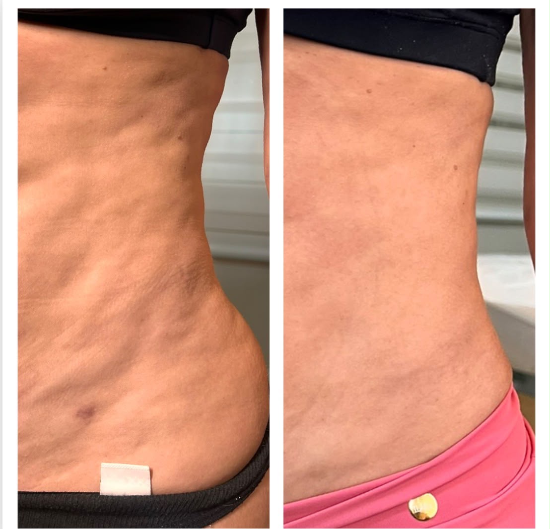 Fibrose conduzida no pós-operatório