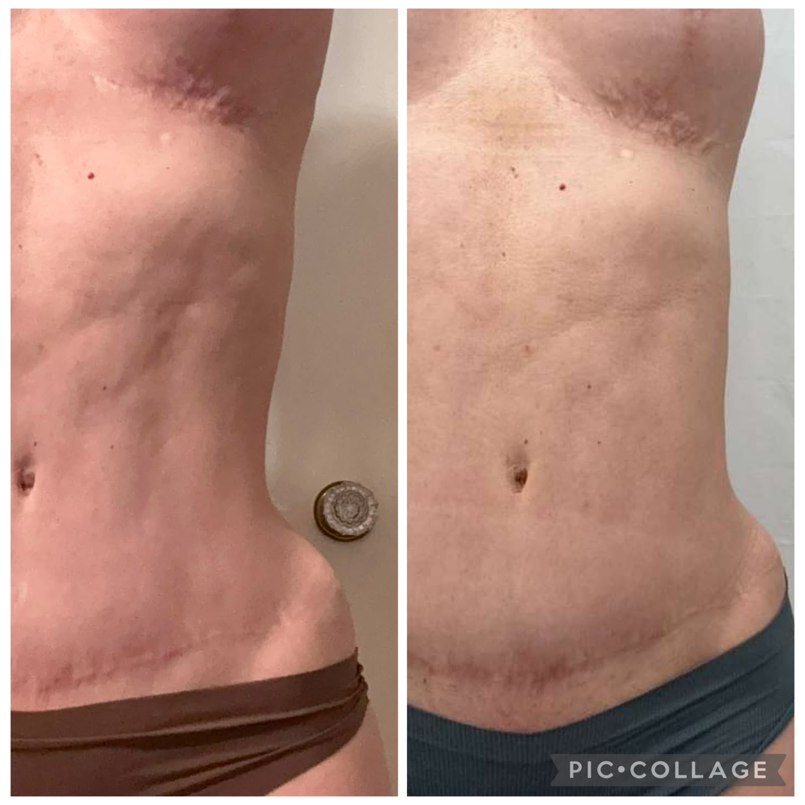 Antes e depois de pós-operatório facial e cervical