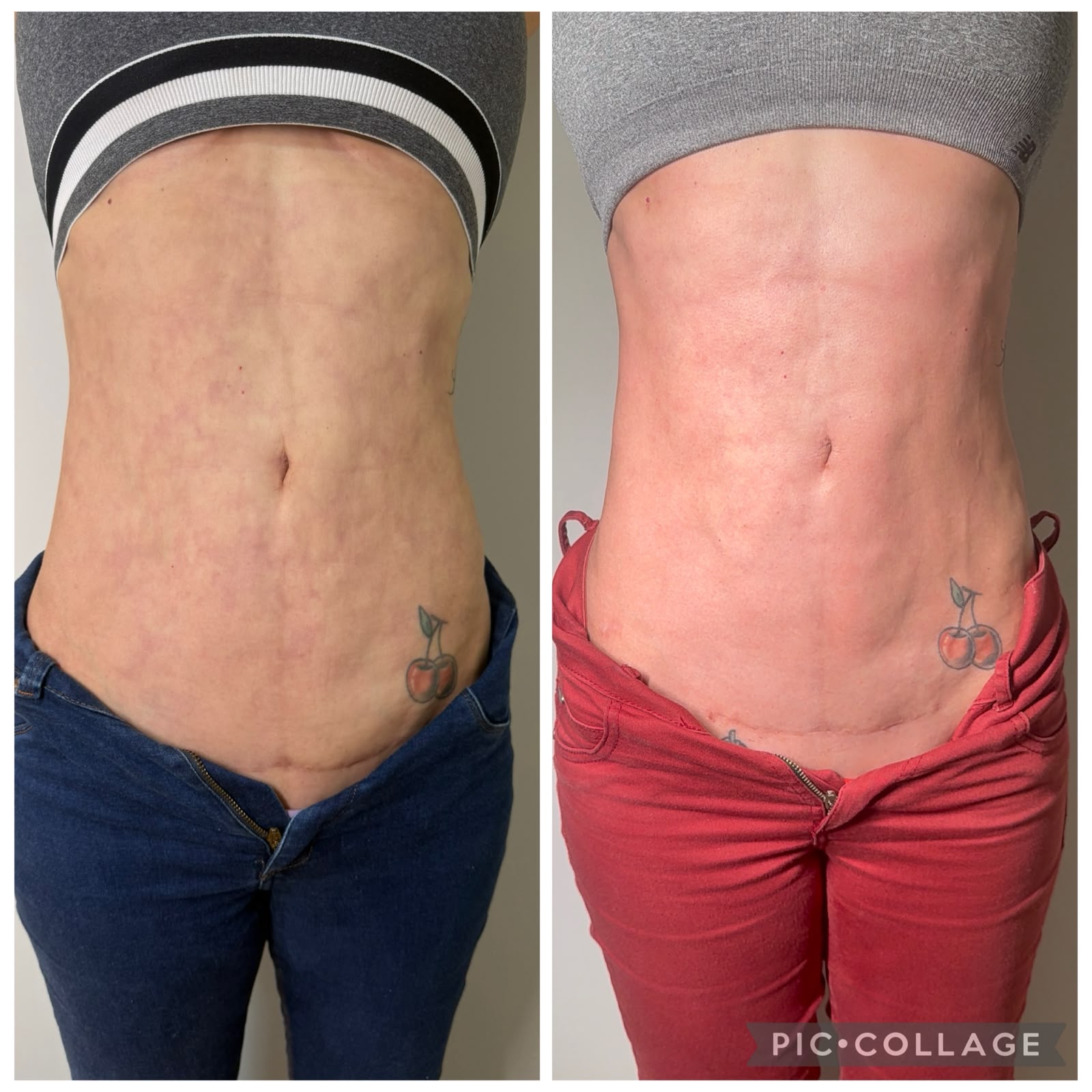Antes e depois de condução de pós-operatório corporal