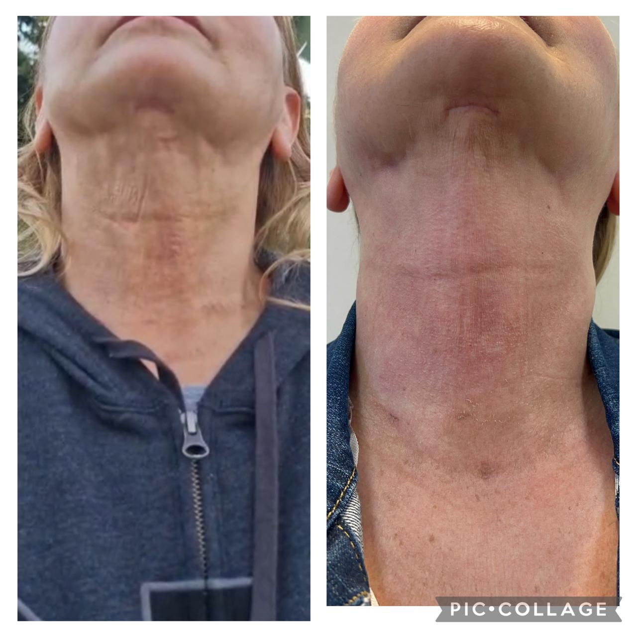 Antes e depois de pós-operatório de pescoço